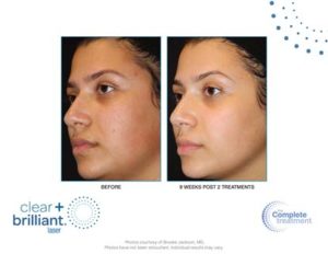 Clear + Brilliant before and after photo