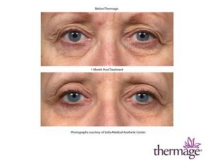 Thermage before and after photo