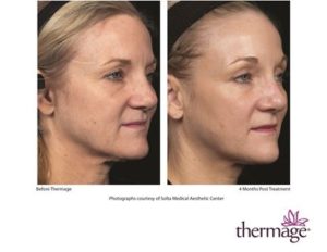 Thermage before and after photo