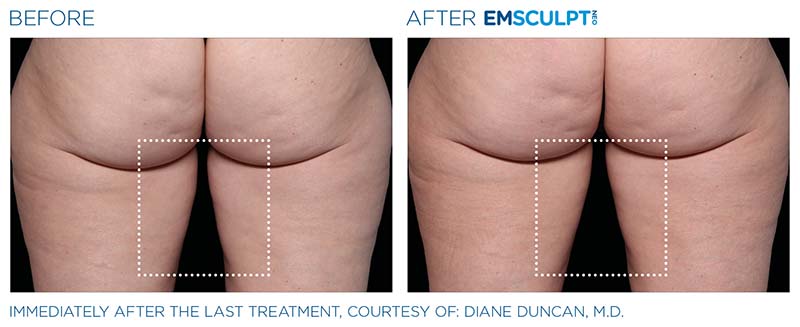 EMSCULPT Neo Before and After 2