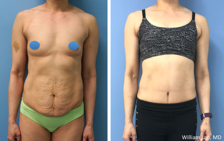 Recent Tummy Tuck before and after - The Avoca Clinic