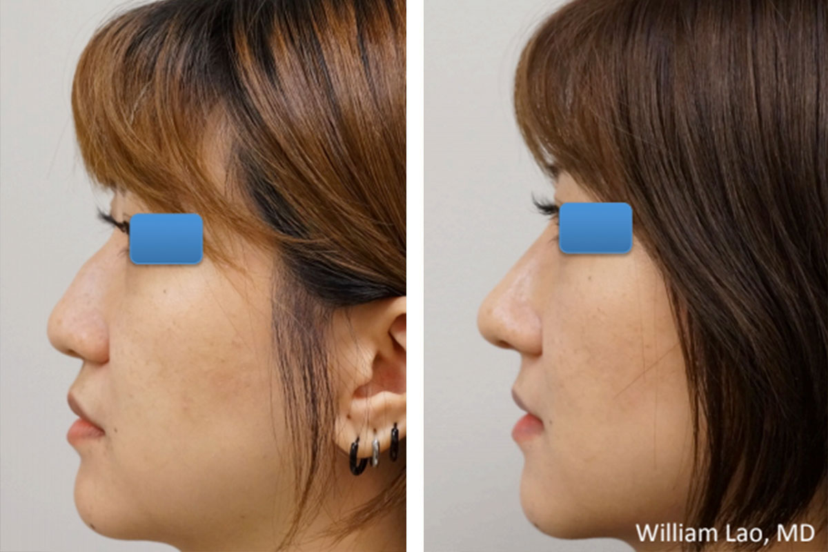 Asian-Rhinoplasty-BxA-8