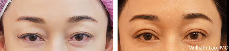 Blepharoplasty-09302017-14