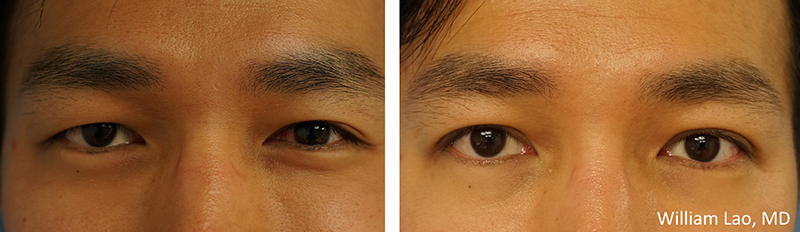 Blepharoplasty-09302017-21