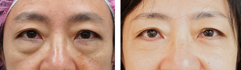 Blepharoplasty-09302017-25