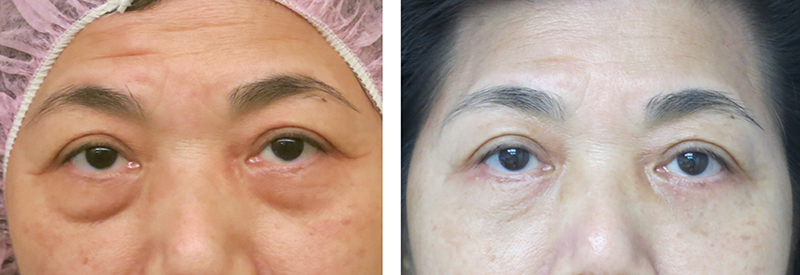 Blepharoplasty-09302017-27