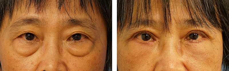 Blepharoplasty-09302017-36