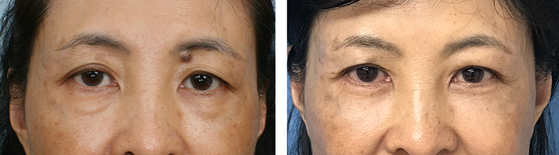 Blepharoplasty-09302017-40