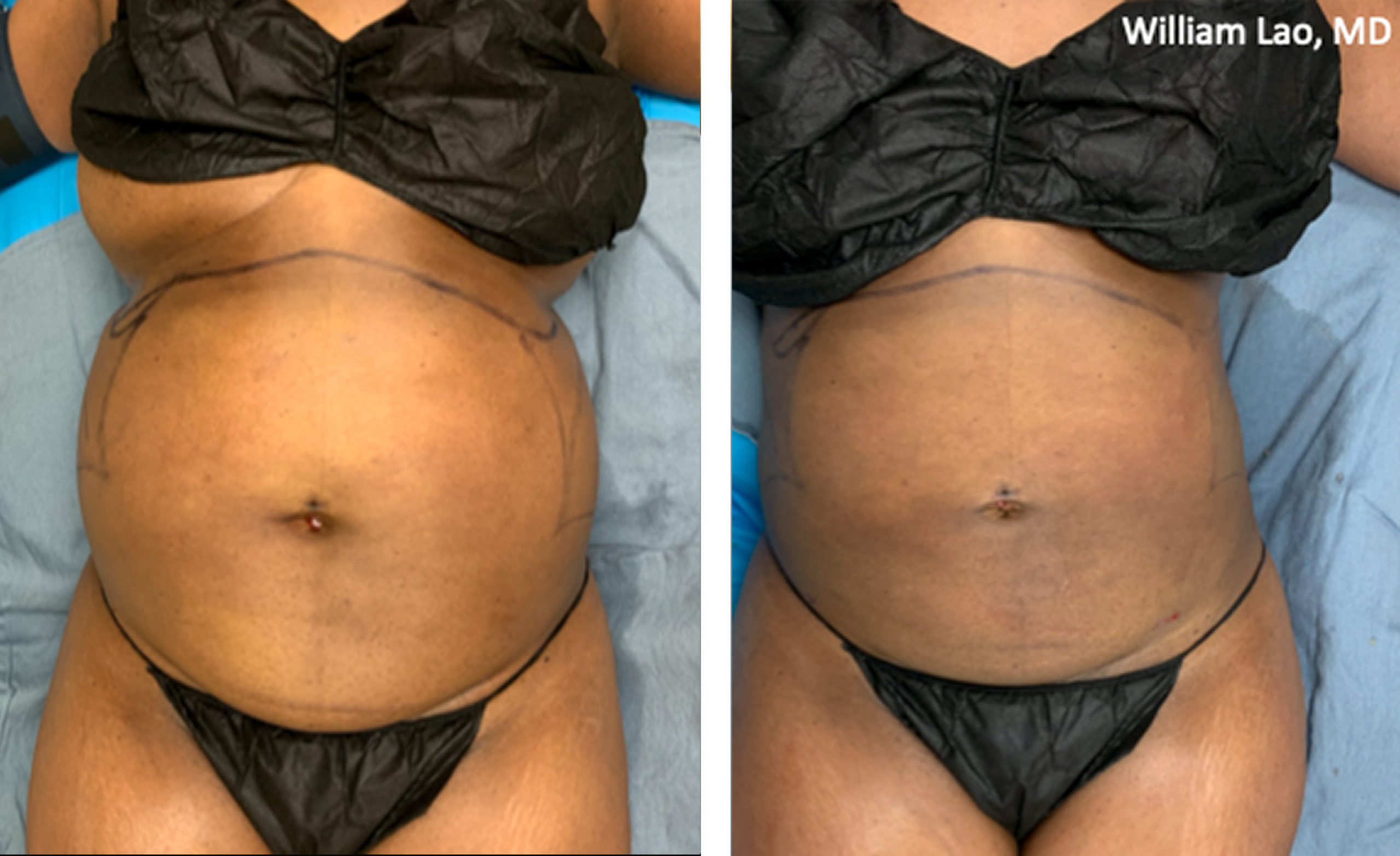 Liposuction-62320-4