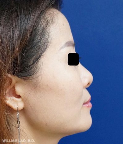 鼻整形手術| 面部| 診療介紹| 駱瑋凱醫學博士