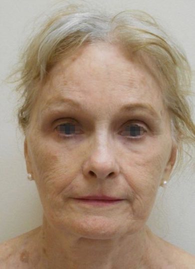 Real patient after facelift photo