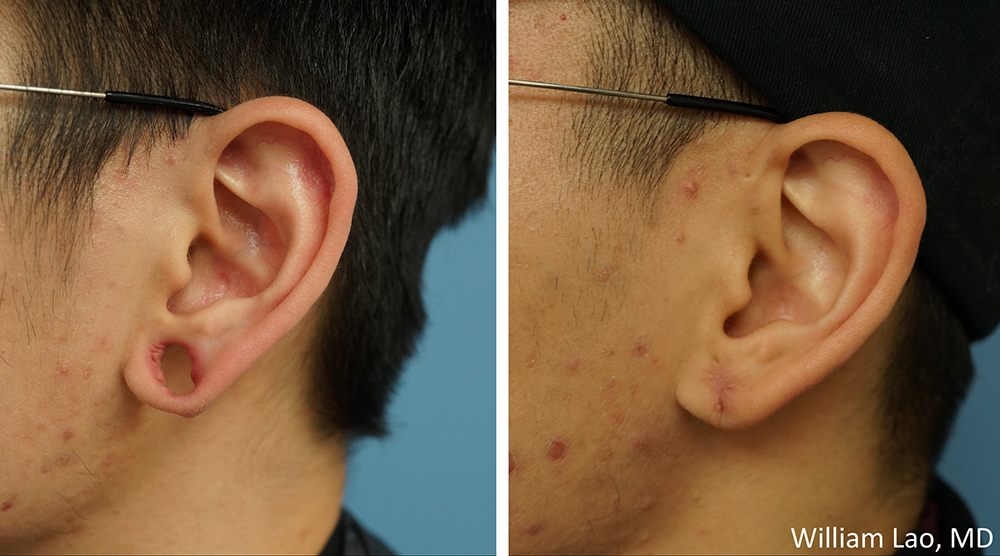 ear-6