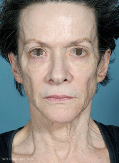 Real patient before facelift photo