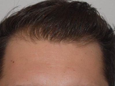 Real patient before facelift photo