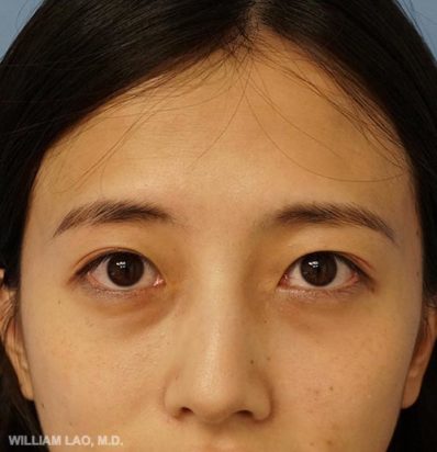 Real patient before facelift photo