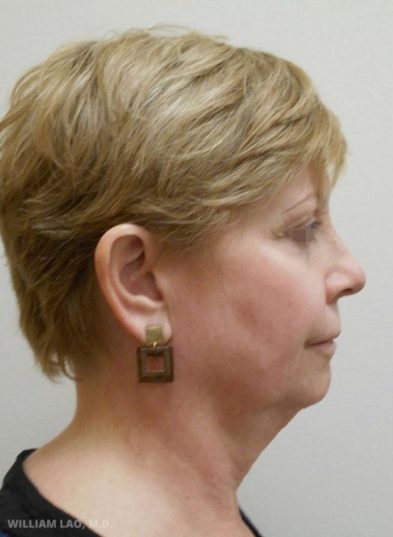 Real patient before facelift photo