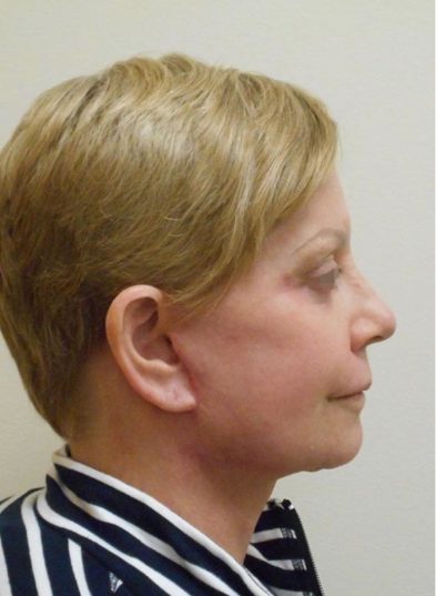 Real patient after facelift photo