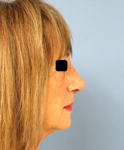 Real patient after facelift photo