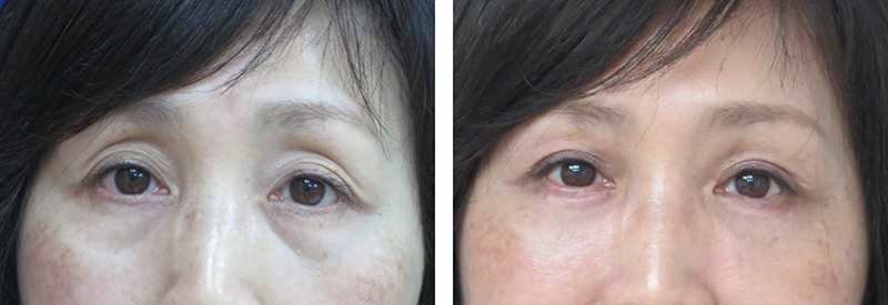 Blepharoplasty-09302017-38