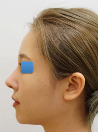 Real patient after Asian Rhinoplasty photo