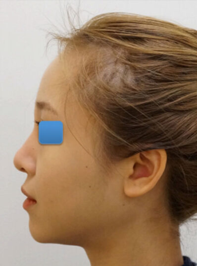 Real patient before Asian Rhinoplasty photo