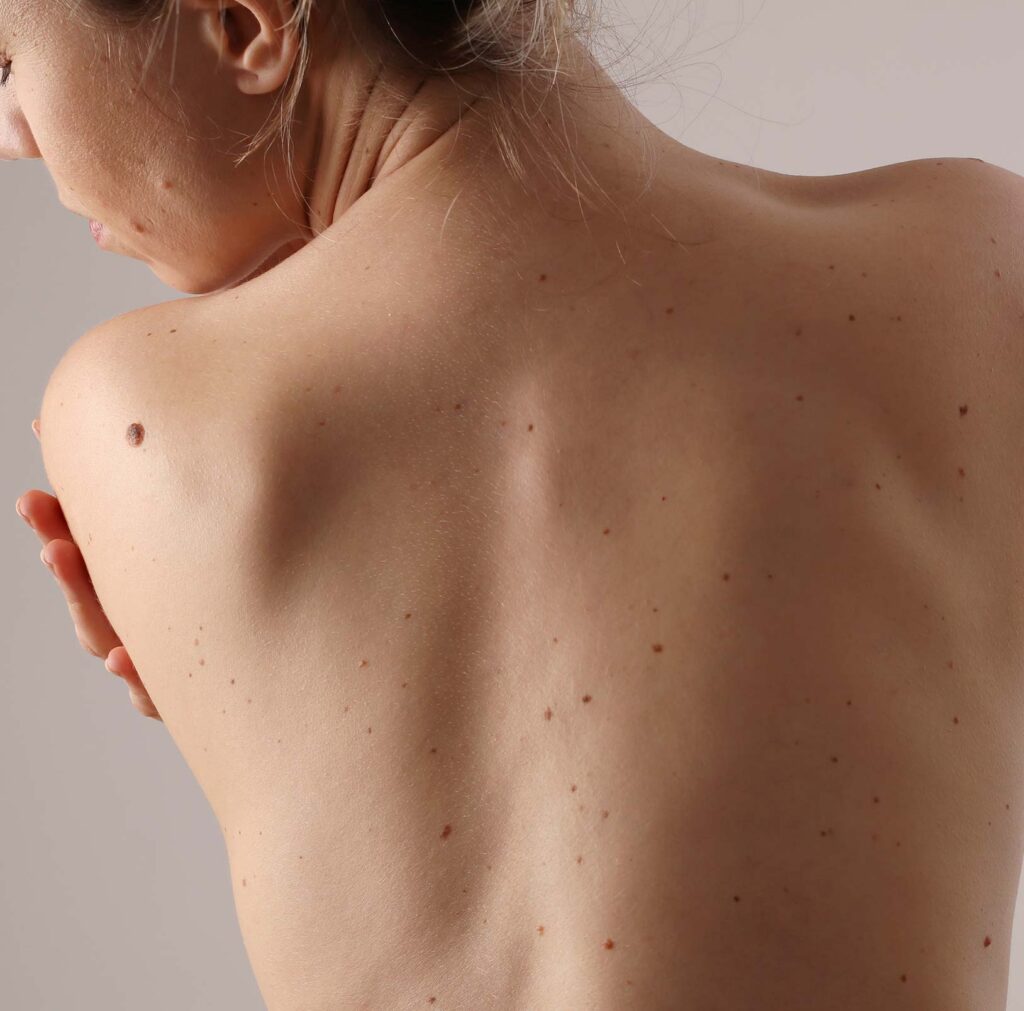 Woman with moles on her back