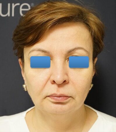 Real patient before facelift photo