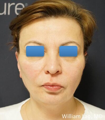 Real patient after facelift photo