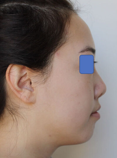 Real patient before facelift photo