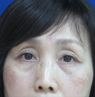 Real patient before facelift photo