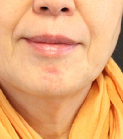 Real patient after facelift photo