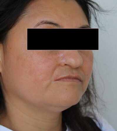 Real patient before facelift photo