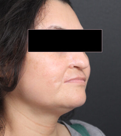 Real patient after facelift photo