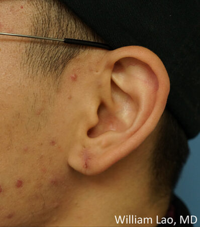 Real patient after facelift photo