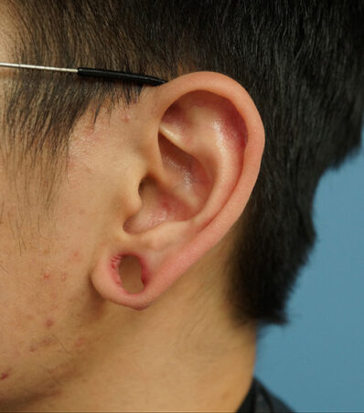 Real patient before facelift photo