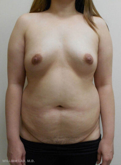Real patient before facelift photo