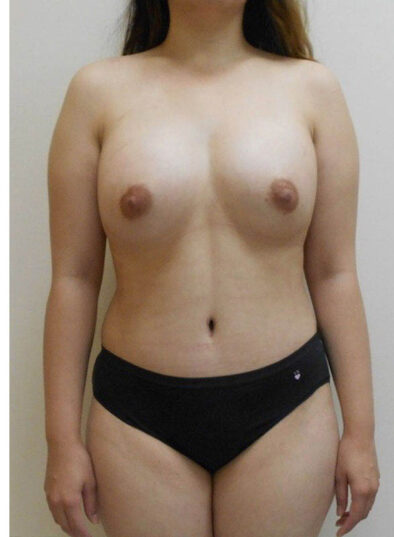 Real patient after facelift photo