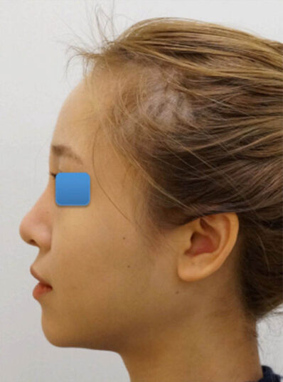 Real patient before facelift photo