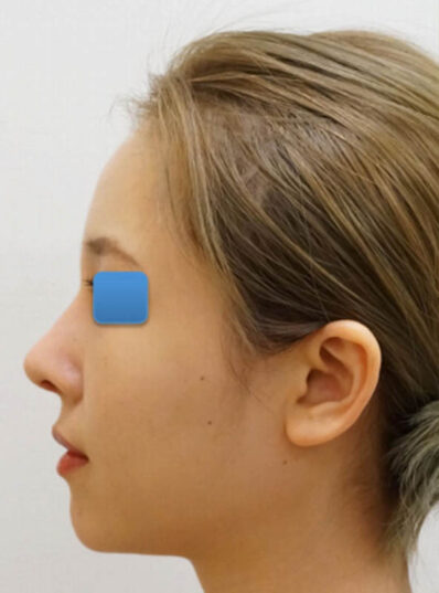 Real patient after facelift photo