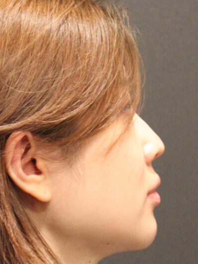 Real patient before facelift photo
