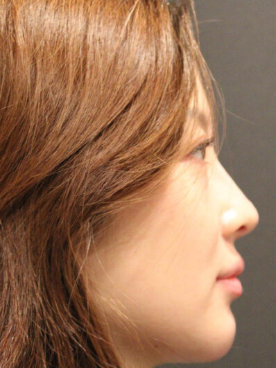 Real patient after facelift photo