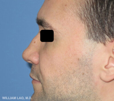 Real patient before facelift photo