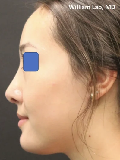 Real patient after facelift photo