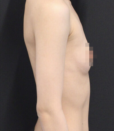 Real patient before facelift photo