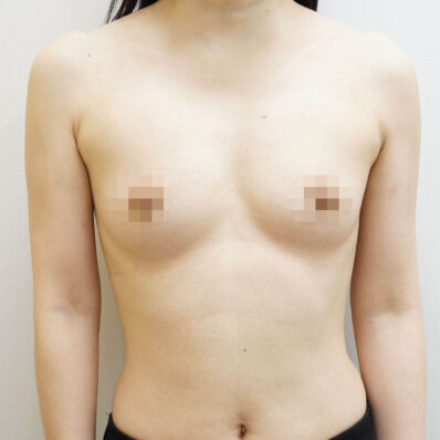 Real patient before facelift photo