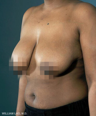 Real patient before facelift photo
