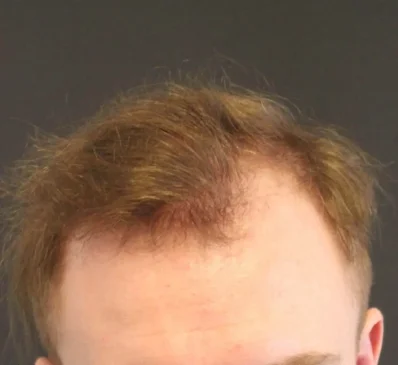 Real patient before facelift photo