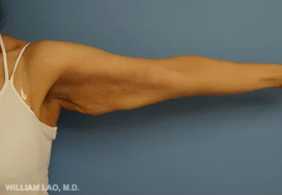 Real patient before facelift photo