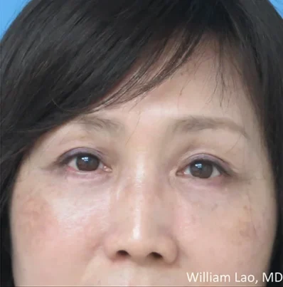 Real patient after facelift photo