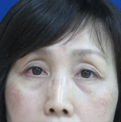 Real patient before facelift photo